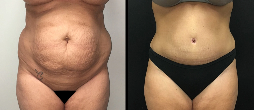 Tummy Tuck Before & After Case Number 00032