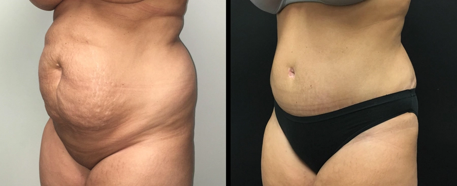Tummy Tuck Before & After Case Number 00032