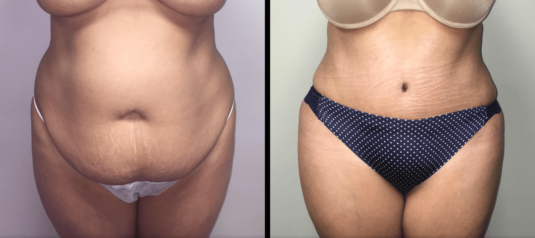 Tummy Tuck Before & After Case Number 00033