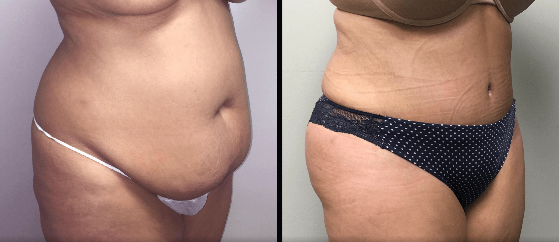 Tummy Tuck Before & After Case Number 00033