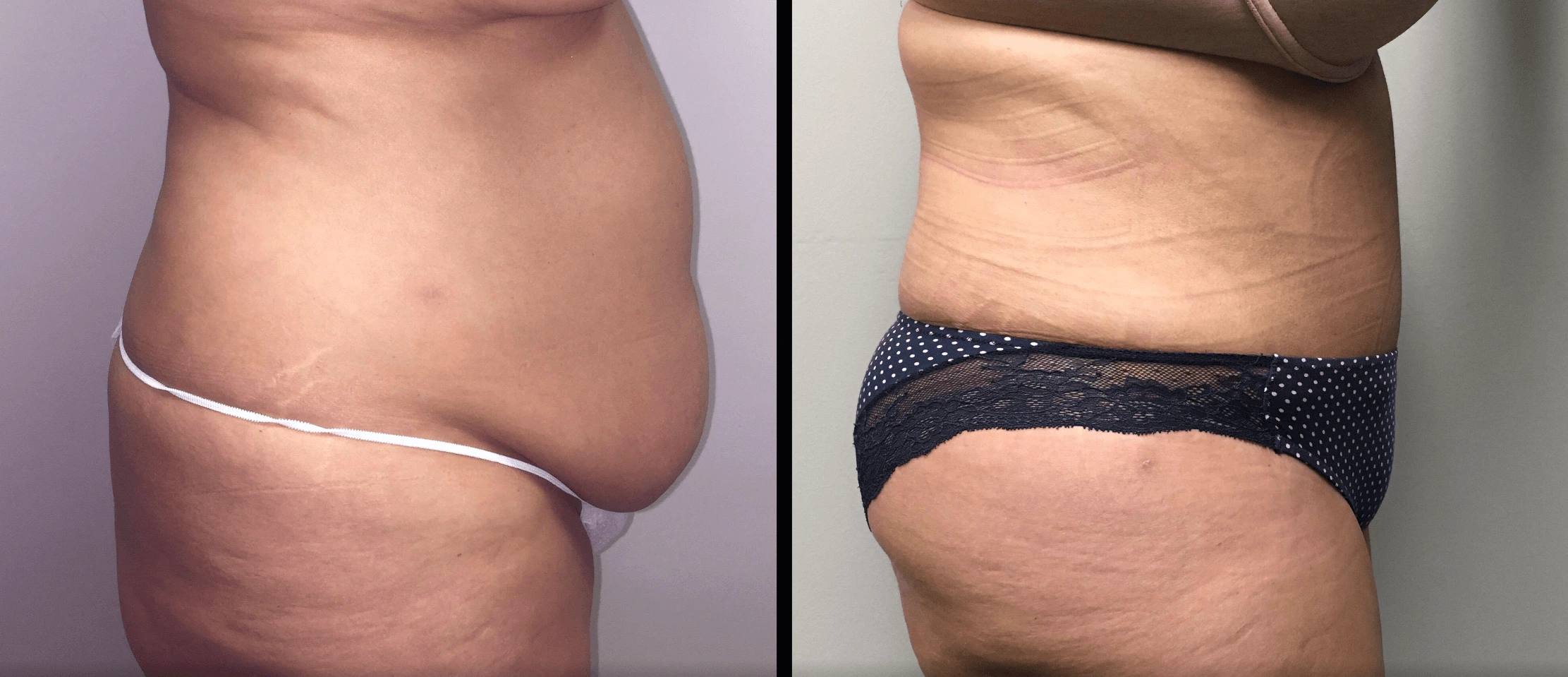 Tummy Tuck Before & After Case Number 00033
