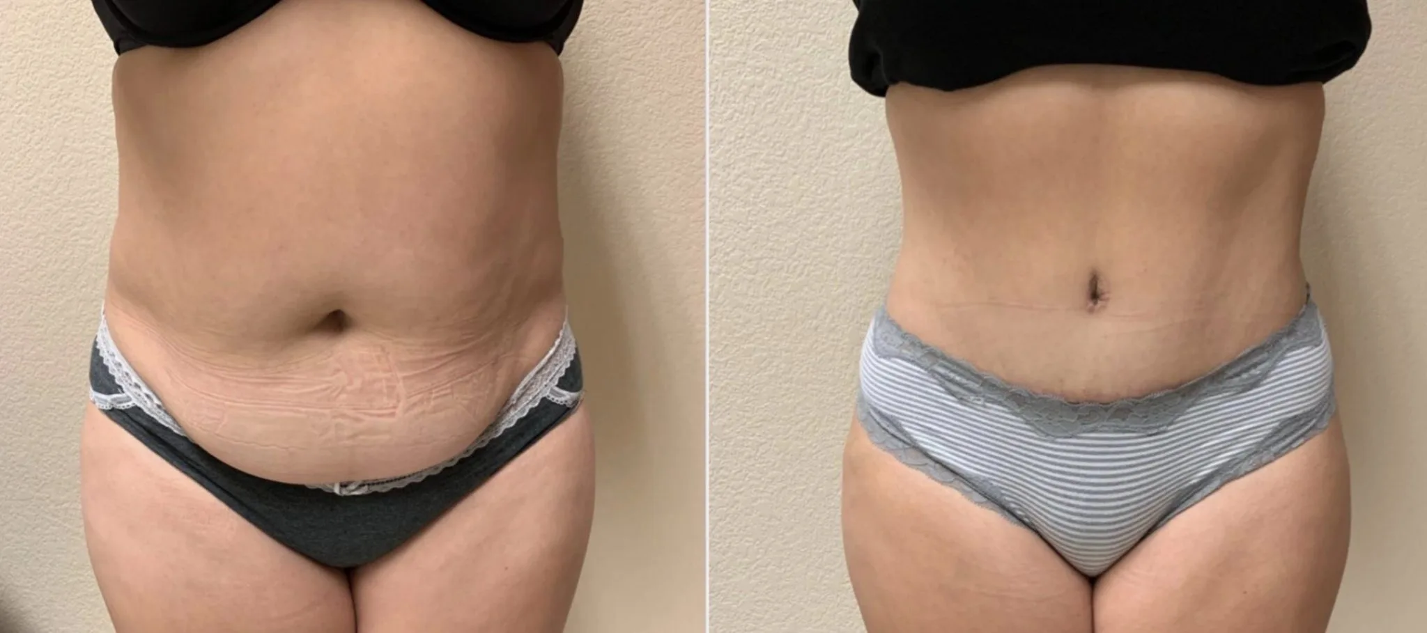 Tummy Tuck Before & After Case Number 00034