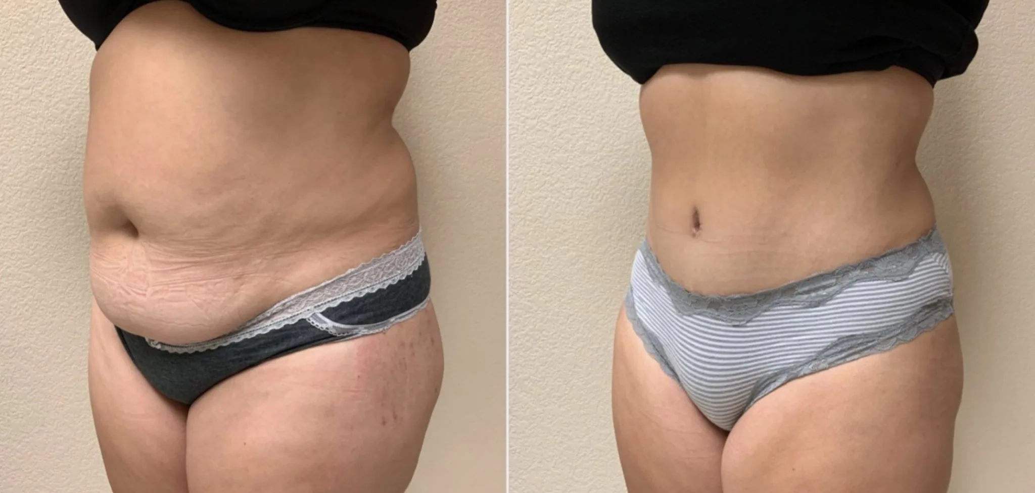 Tummy Tuck Before & After Case Number 00034