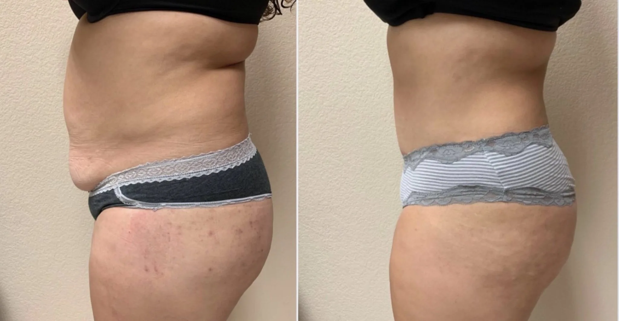 Tummy Tuck Before & After Case Number 00034