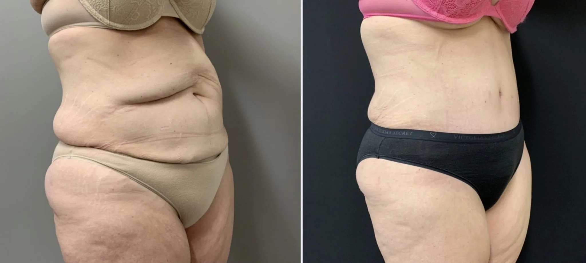 Tummy Tuck Before & After Case Number 00035
