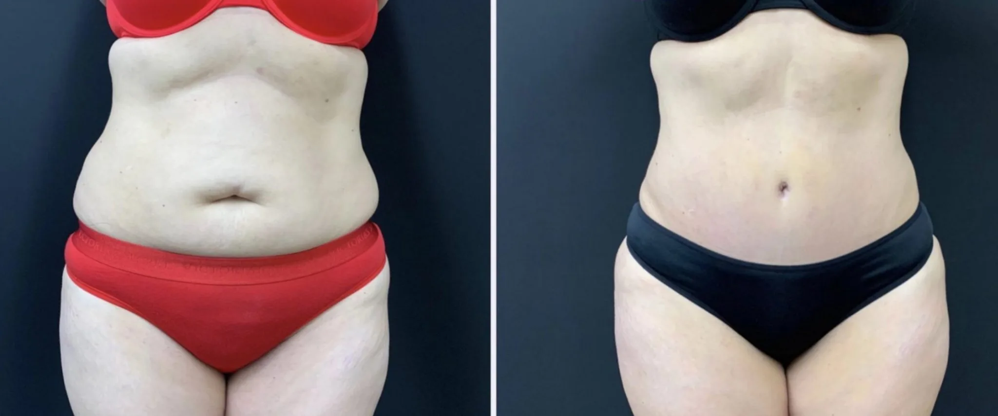 Tummy Tuck Before & After Case Number 00036
