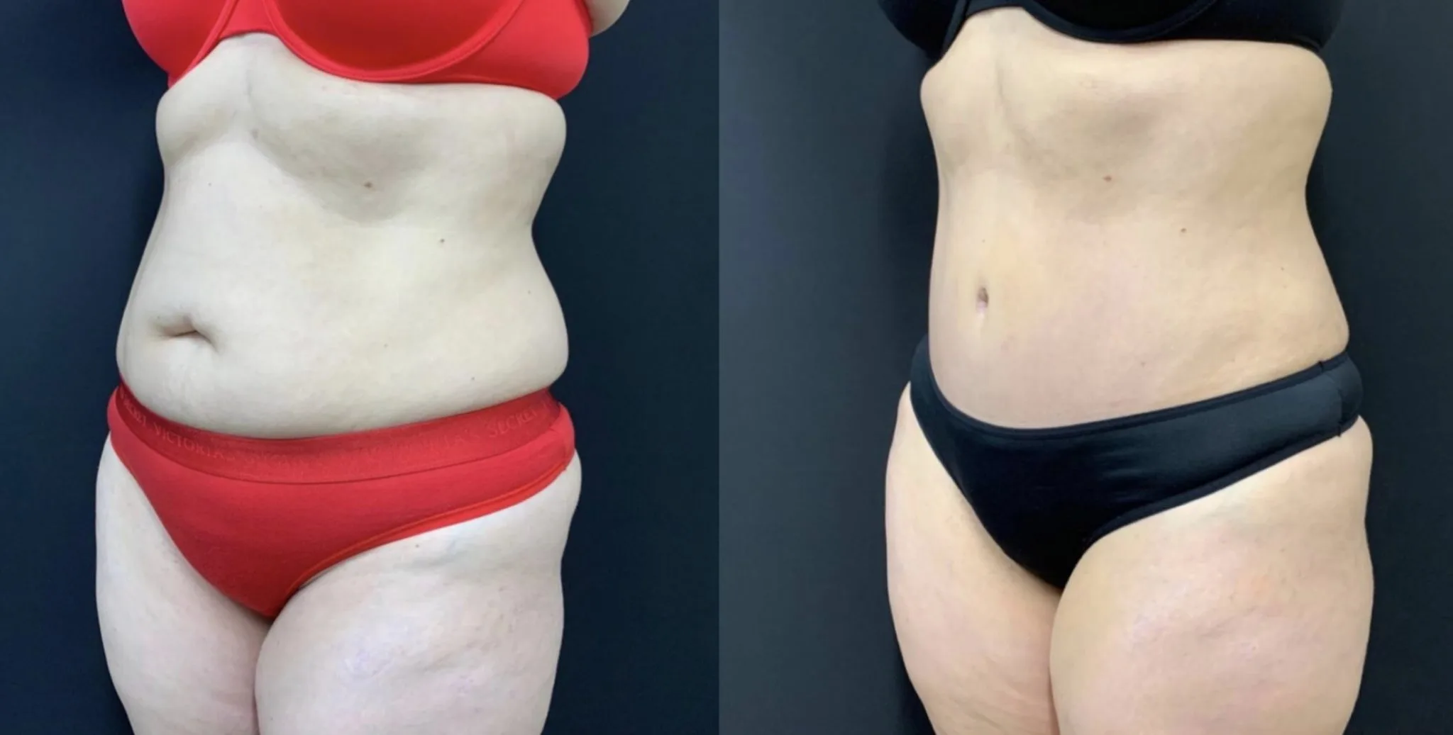Tummy Tuck Before & After Case Number 00036