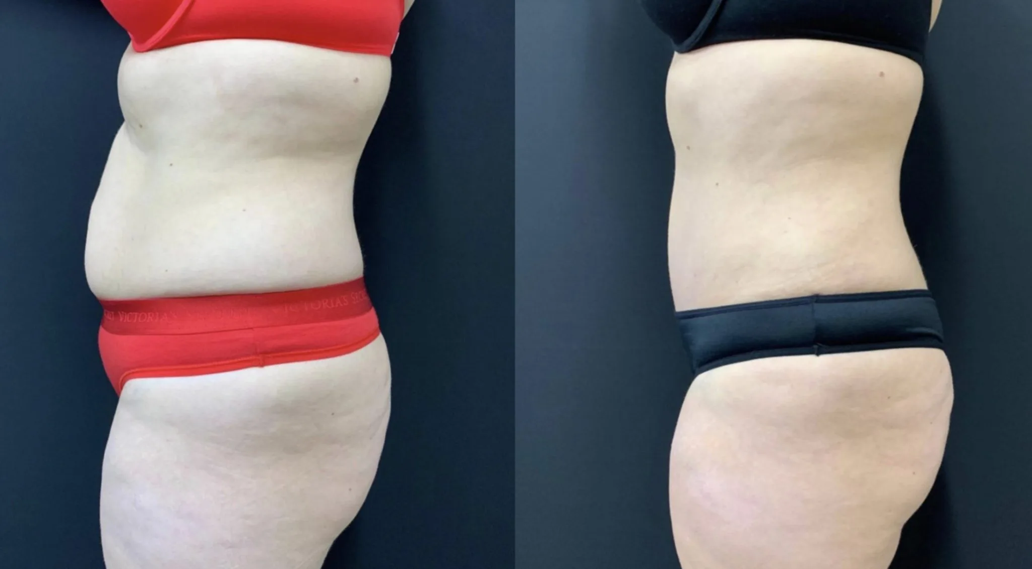 Tummy Tuck Before & After Case Number 00036