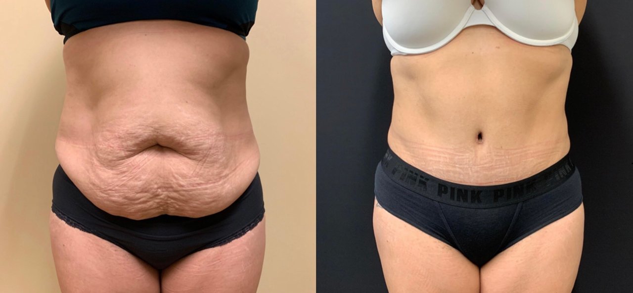 Tummy Tuck Before & After Case Number 00037
