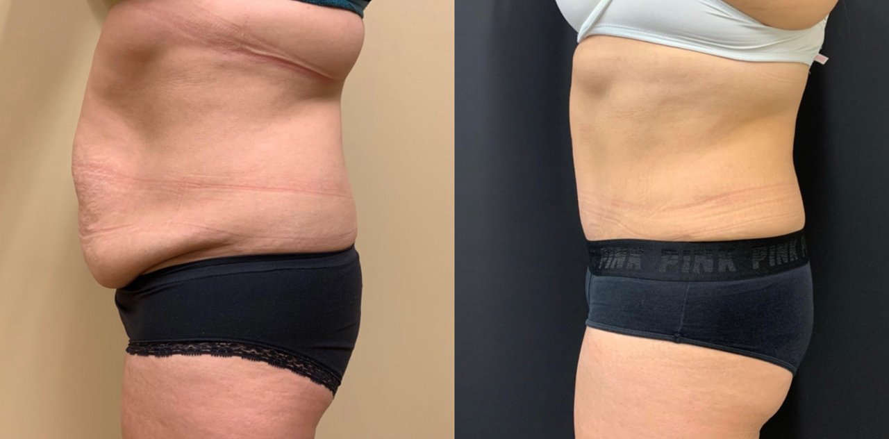 Tummy Tuck Before & After Case Number 00037