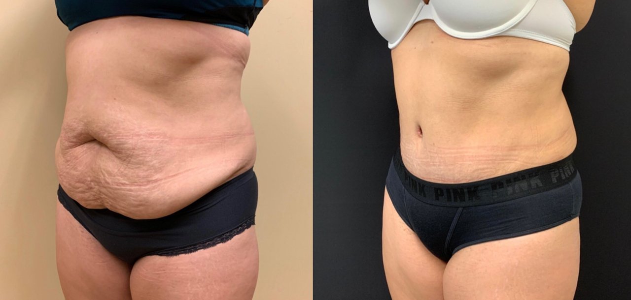 Tummy Tuck Before & After Case Number 00037