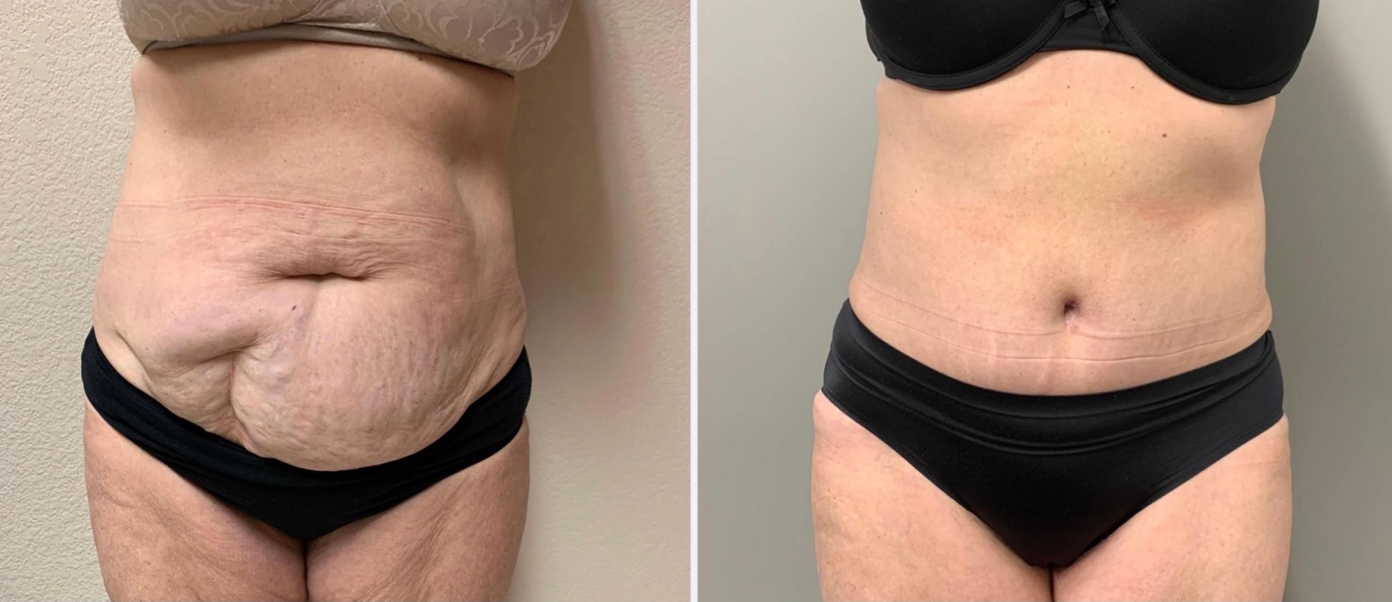 Tummy Tuck Before & After Case Number 00038