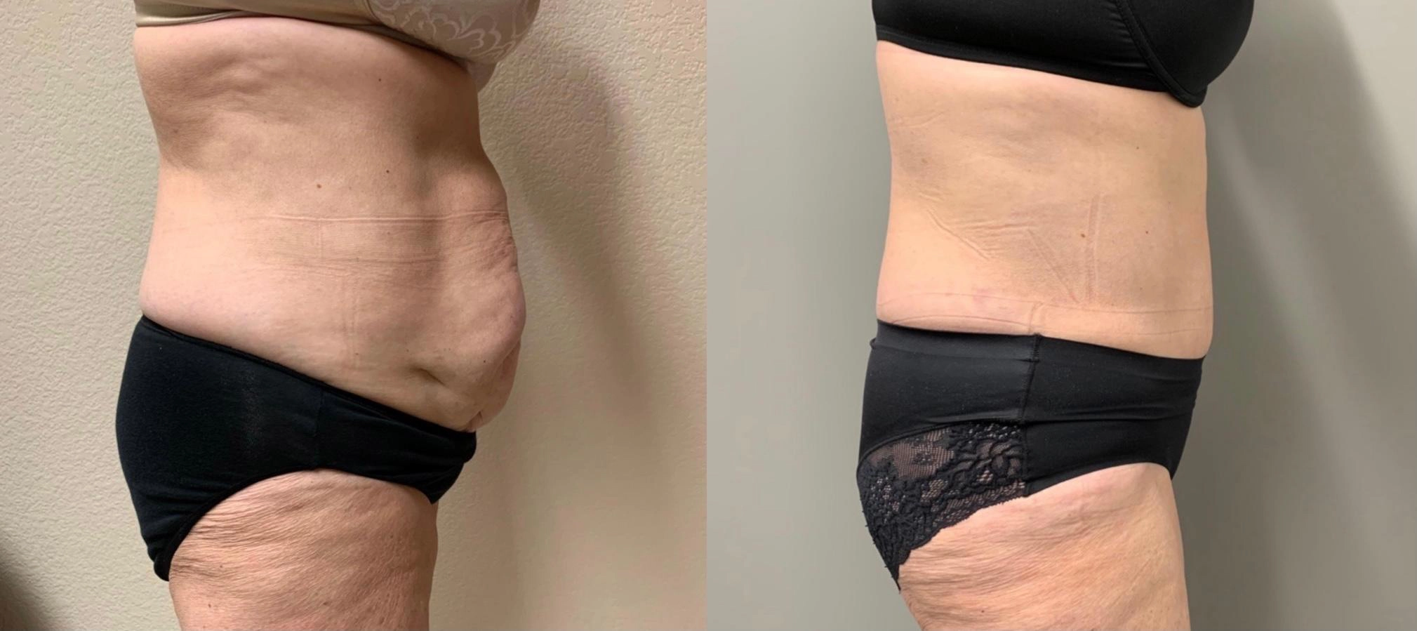 Tummy Tuck Before & After Case Number 00038