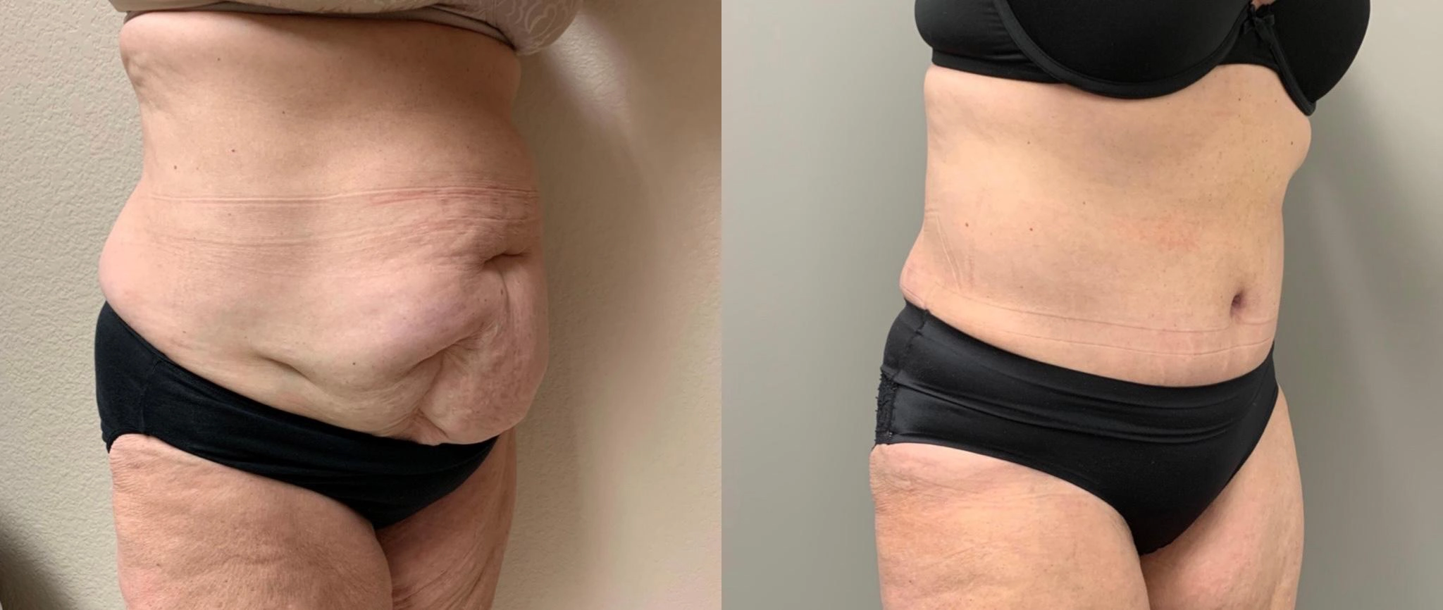 Tummy Tuck Before & After Case Number 00038