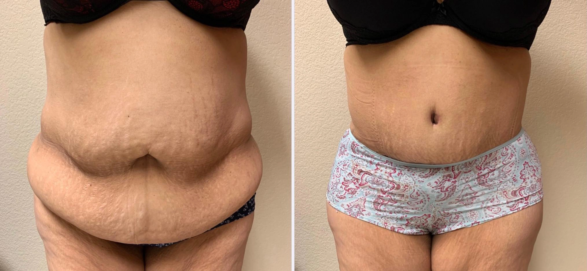 Tummy Tuck Before & After Case Number 00039