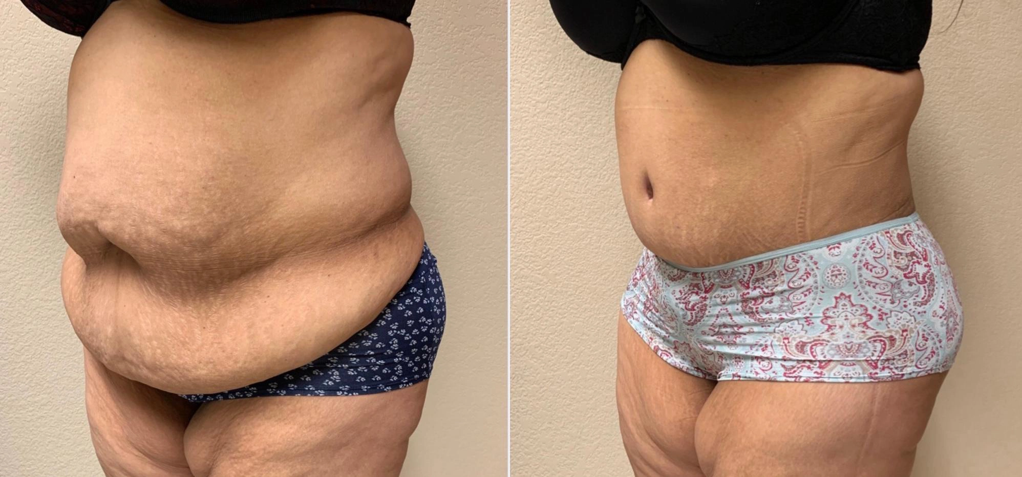 Tummy Tuck Before & After Case Number 00039