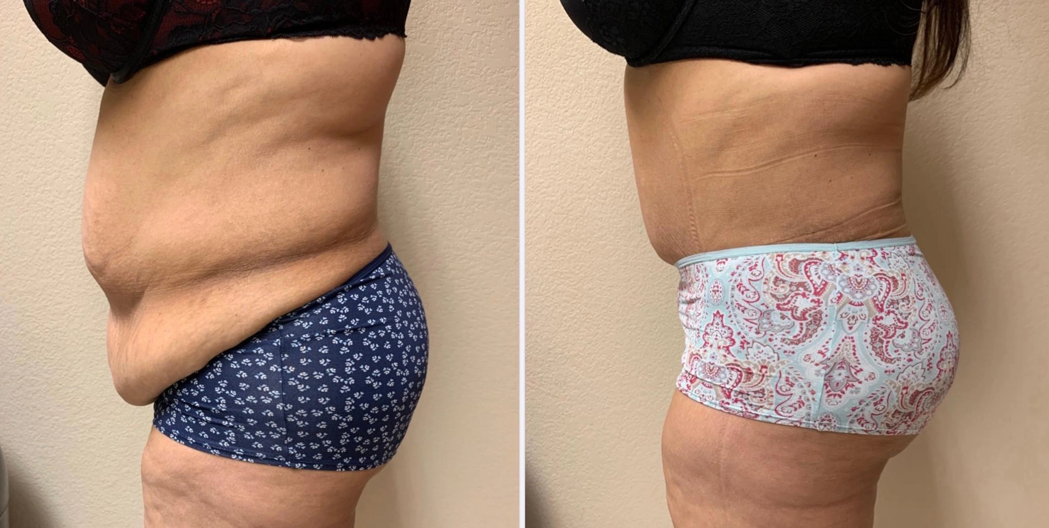 Tummy Tuck Before & After Case Number 00039
