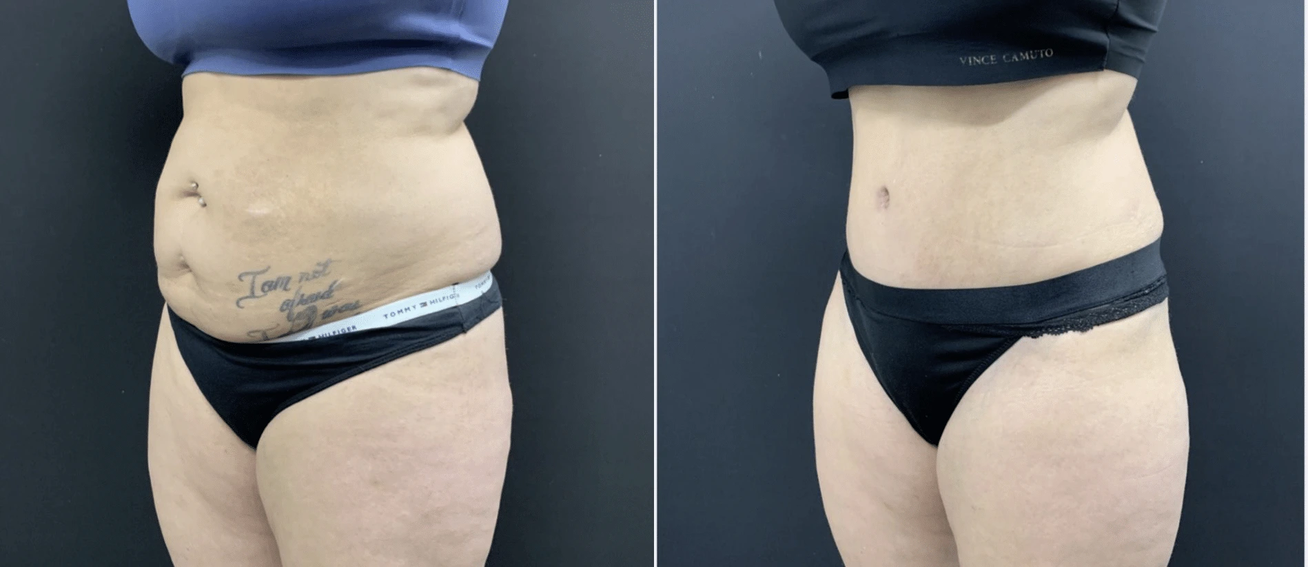 Tummy Tuck Before & After Case Number 0004