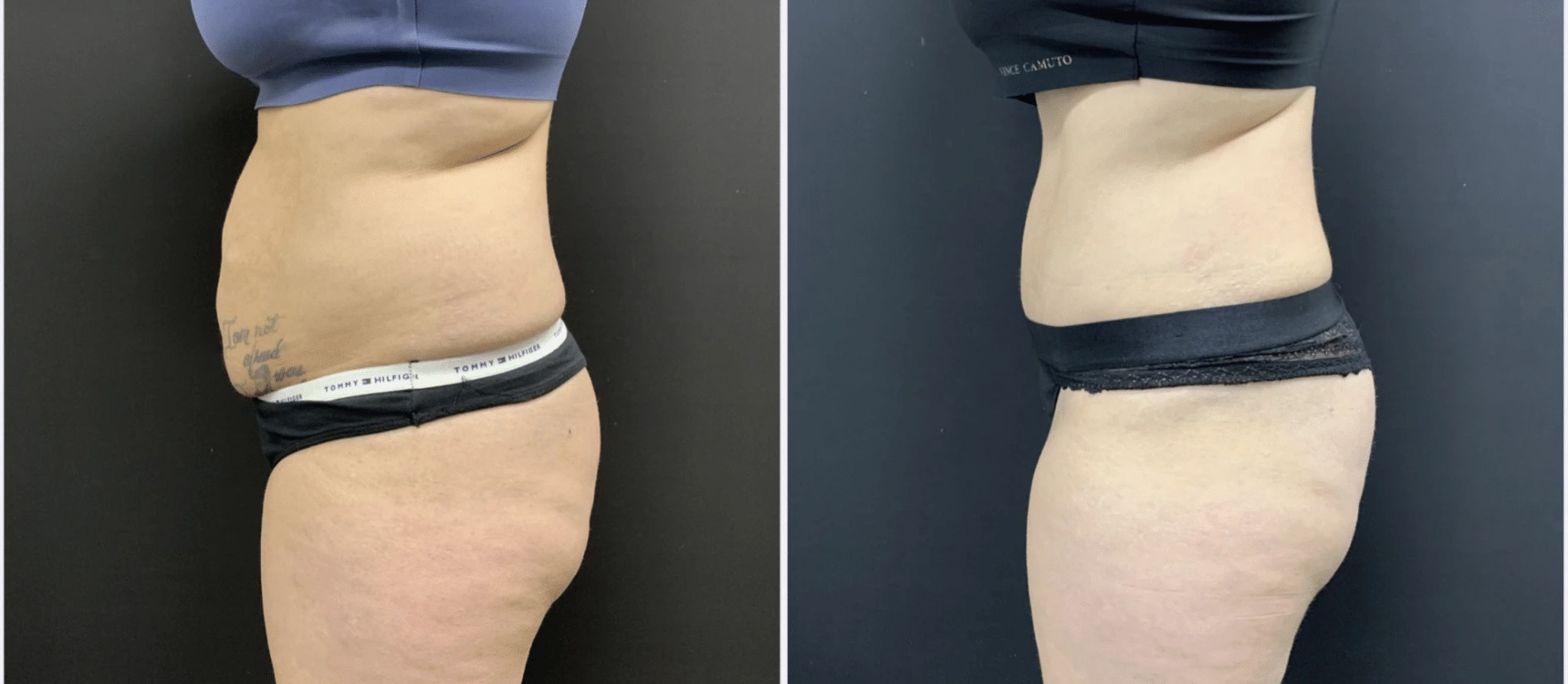 Tummy Tuck Before & After Case Number 0004