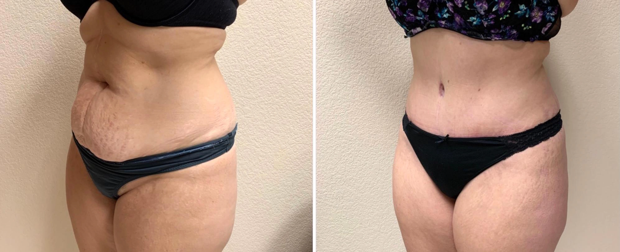 Tummy Tuck Before & After Case Number 00040