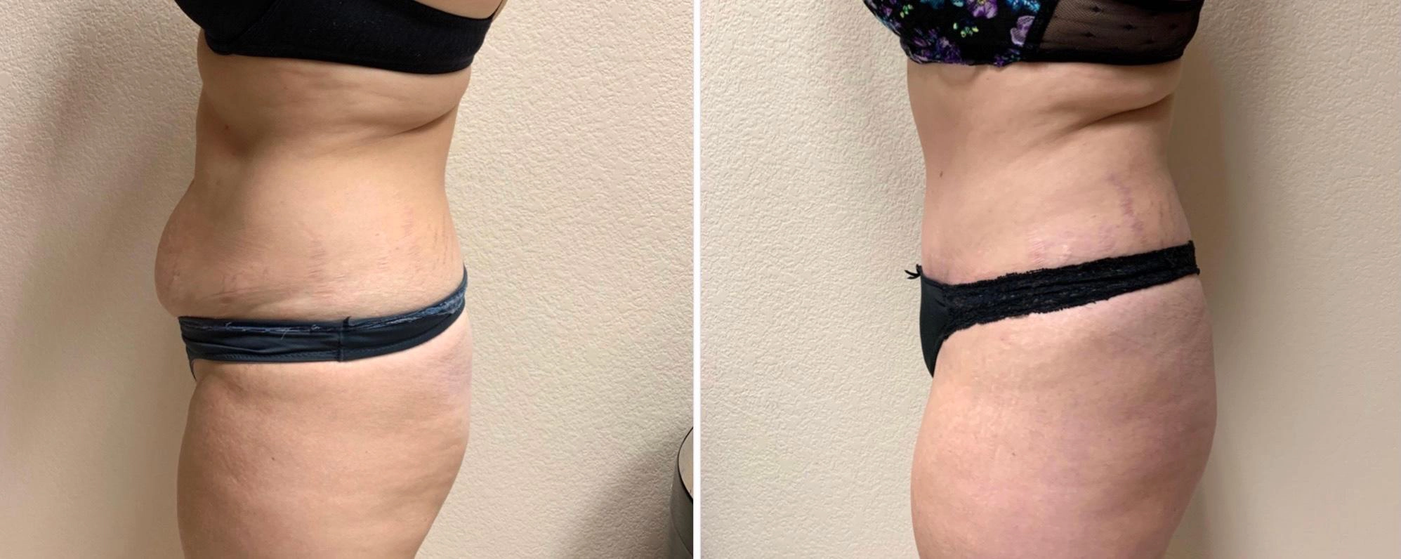 Tummy Tuck Before & After Case Number 00040