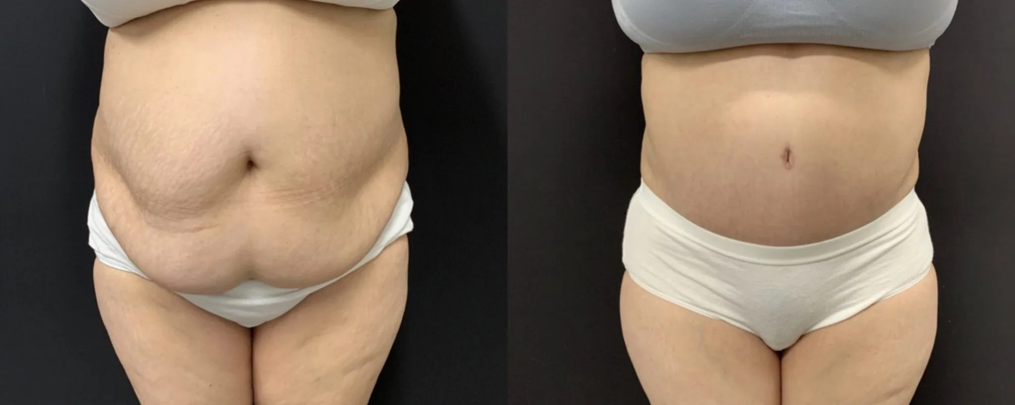 Tummy Tuck Before & After Case Number 00042