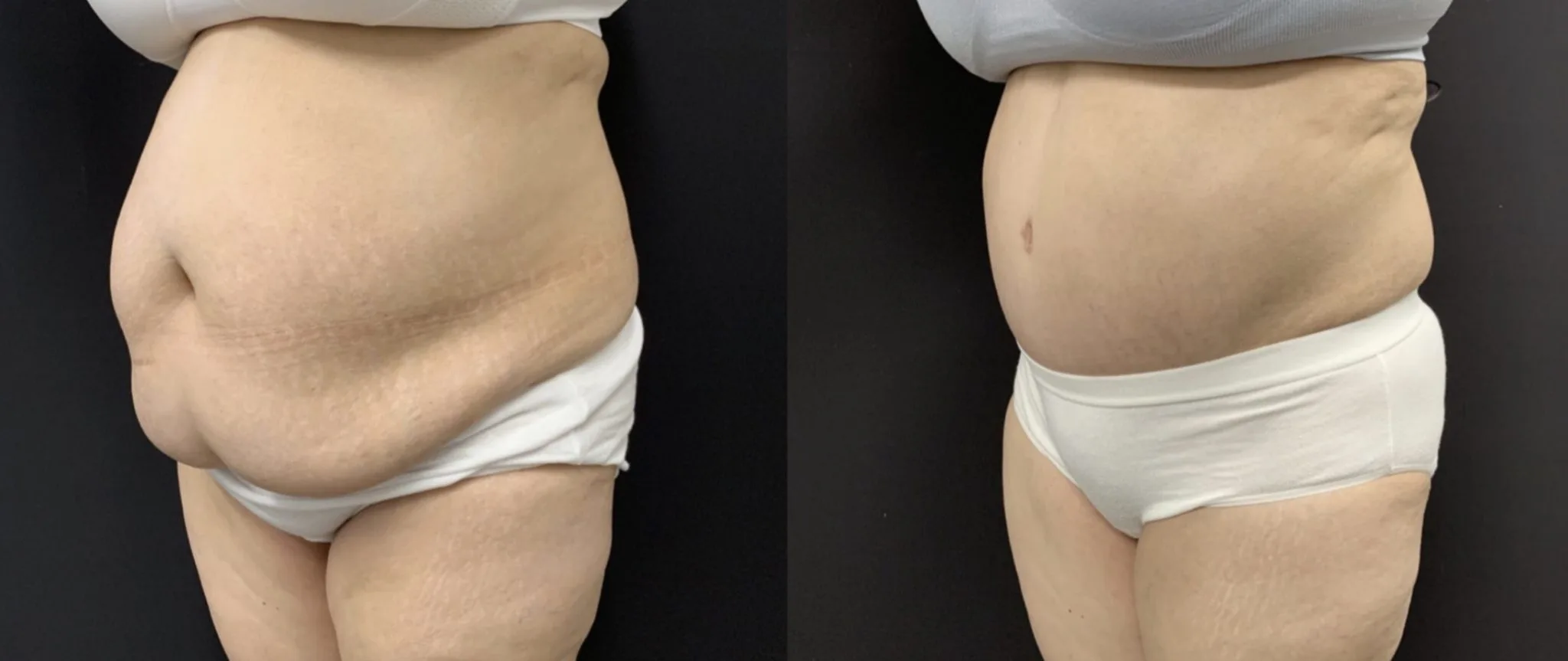 Tummy Tuck Before & After Case Number 00042
