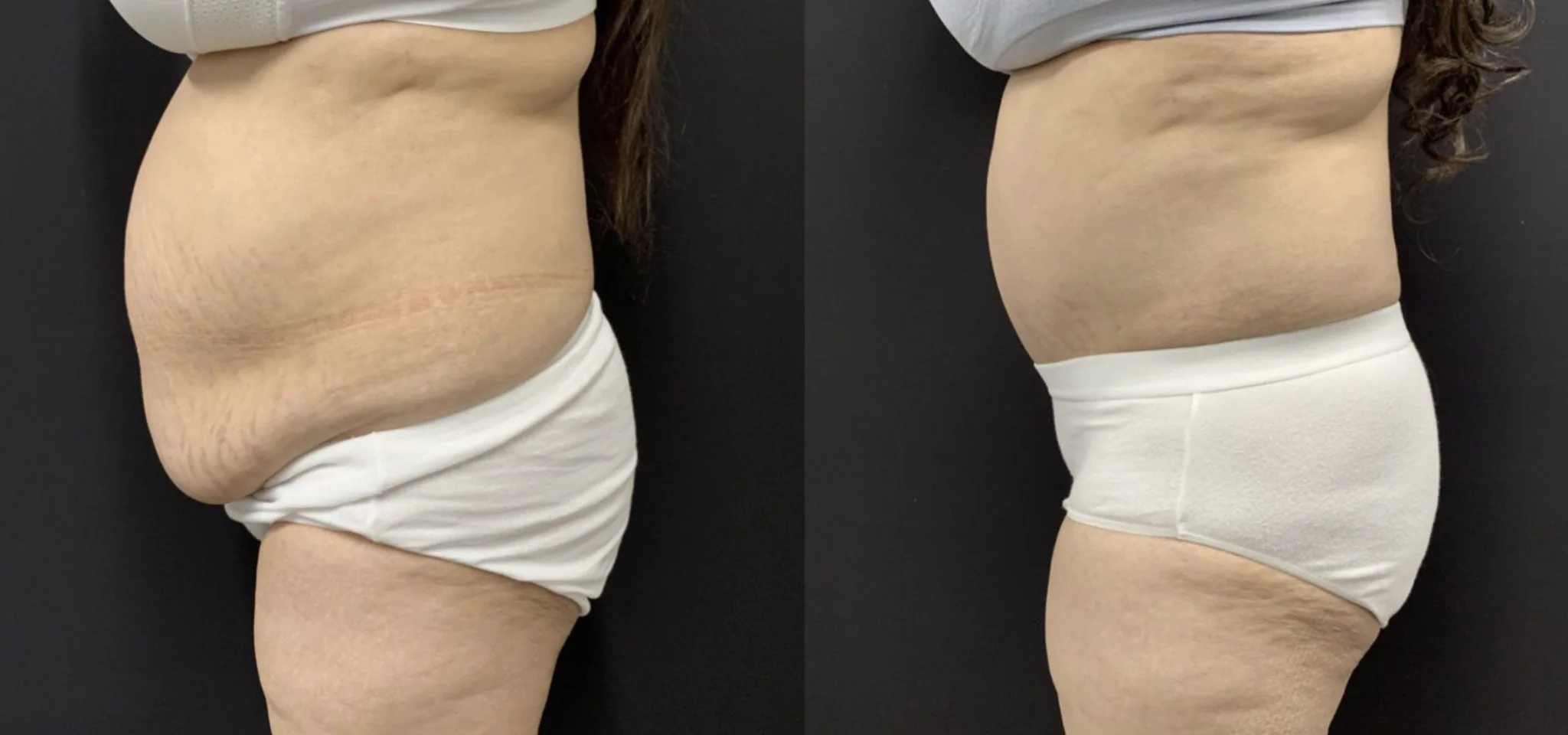 Tummy Tuck Before & After Case Number 00042