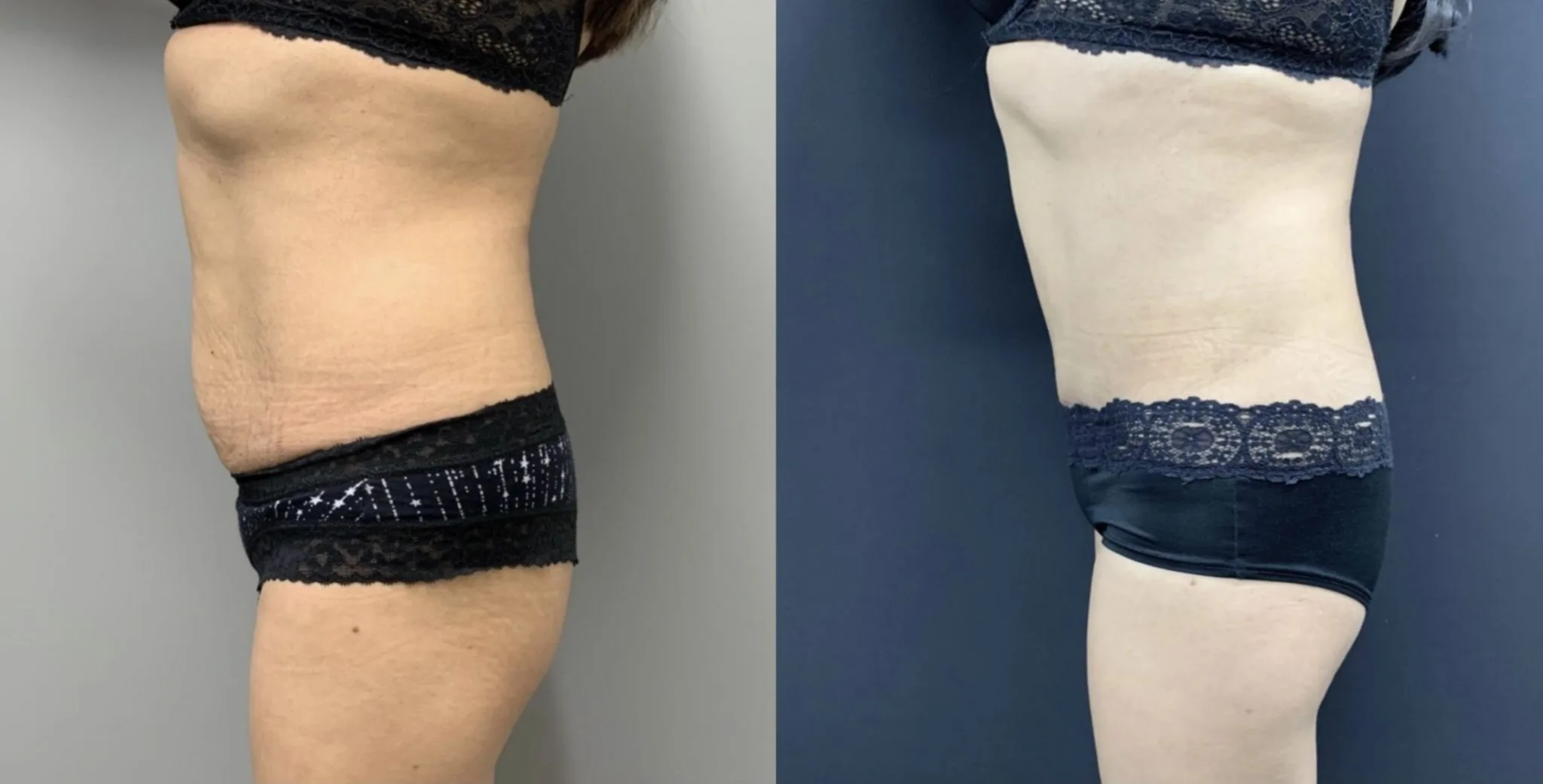 Tummy Tuck Before & After Case Number 00045