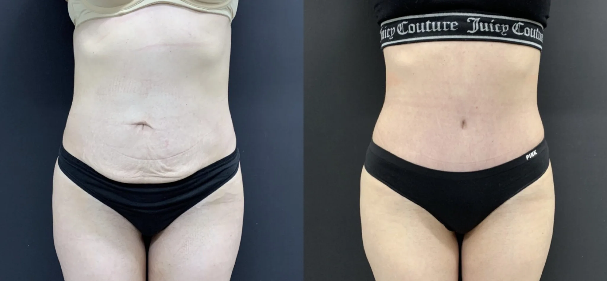 Tummy Tuck Before & After Case Number 00046