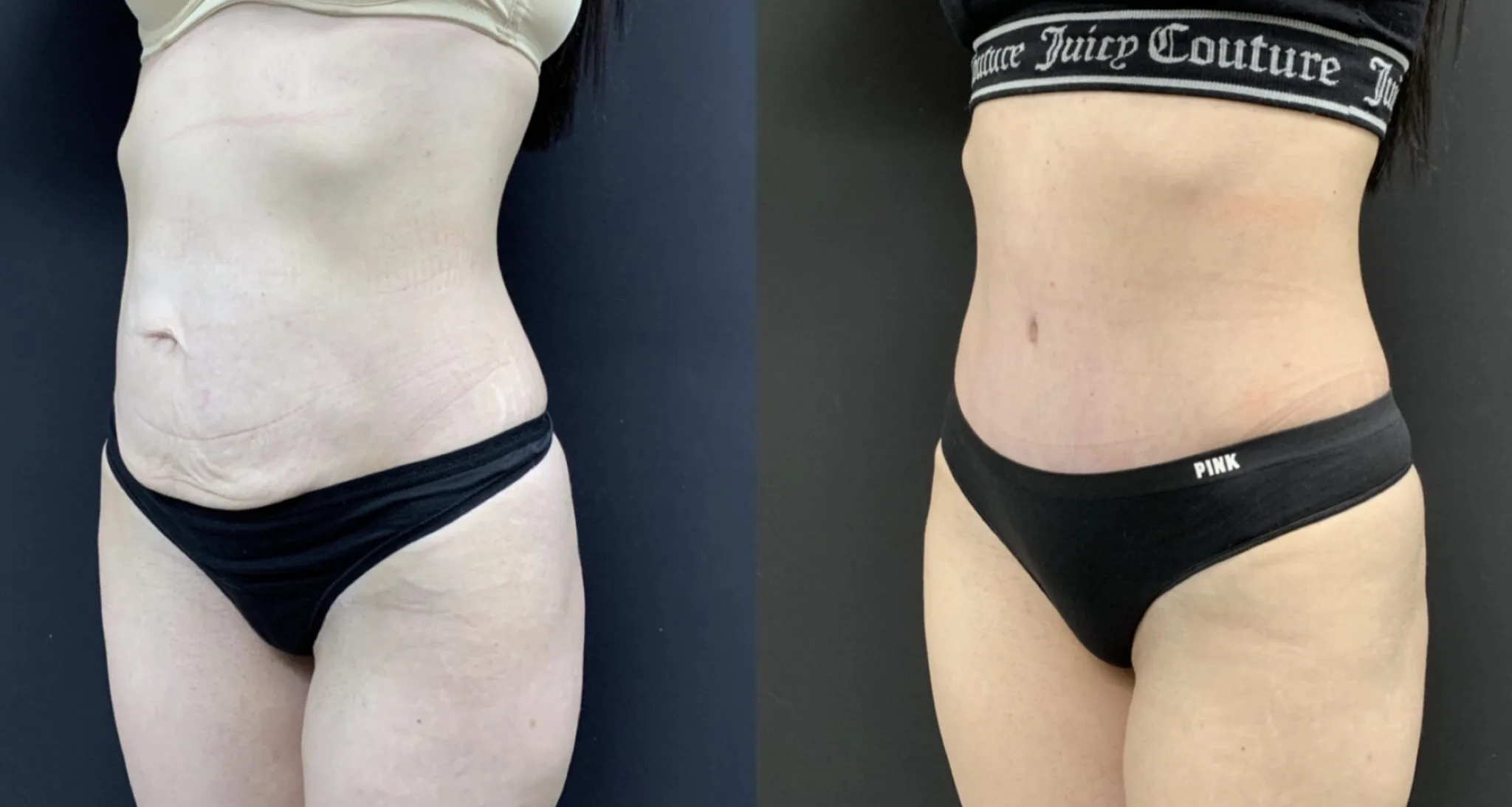 Tummy Tuck Before & After Case Number 00046