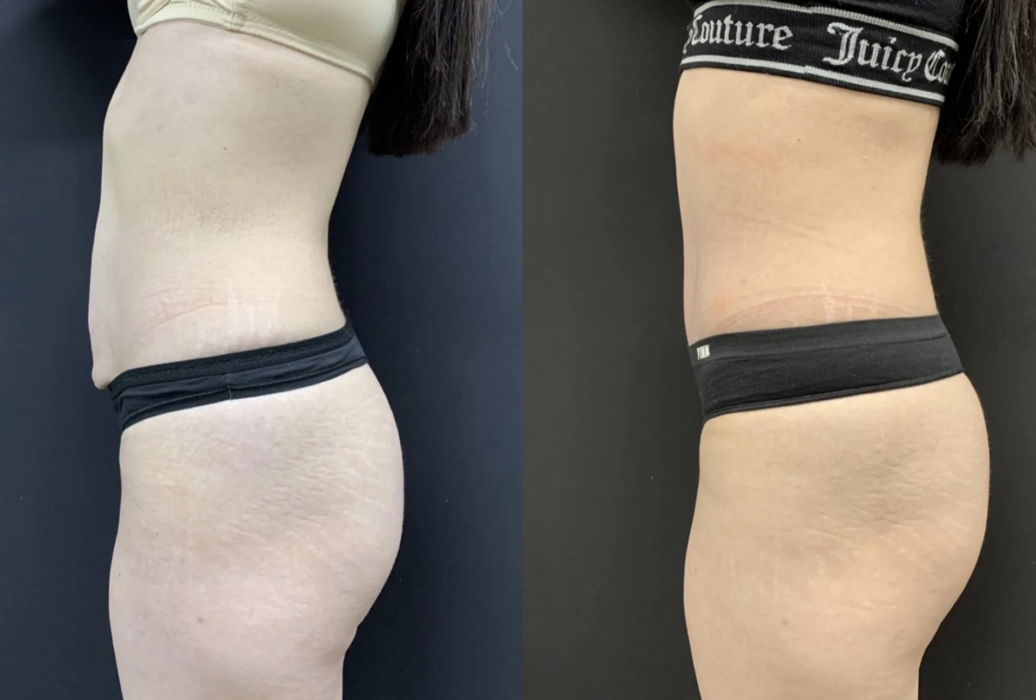 Tummy Tuck Before & After Case Number 00046