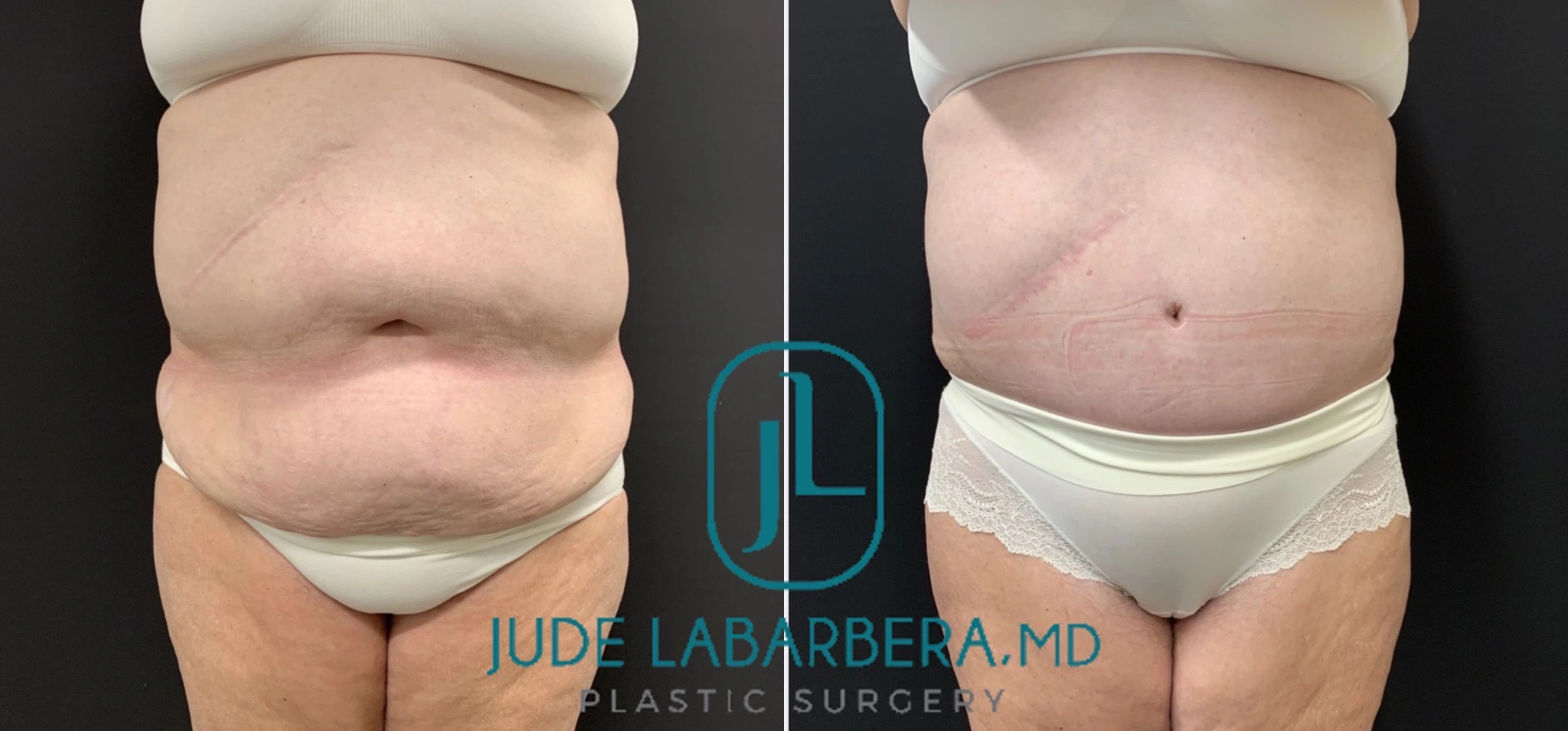Tummy Tuck Before & After Case Number 00047