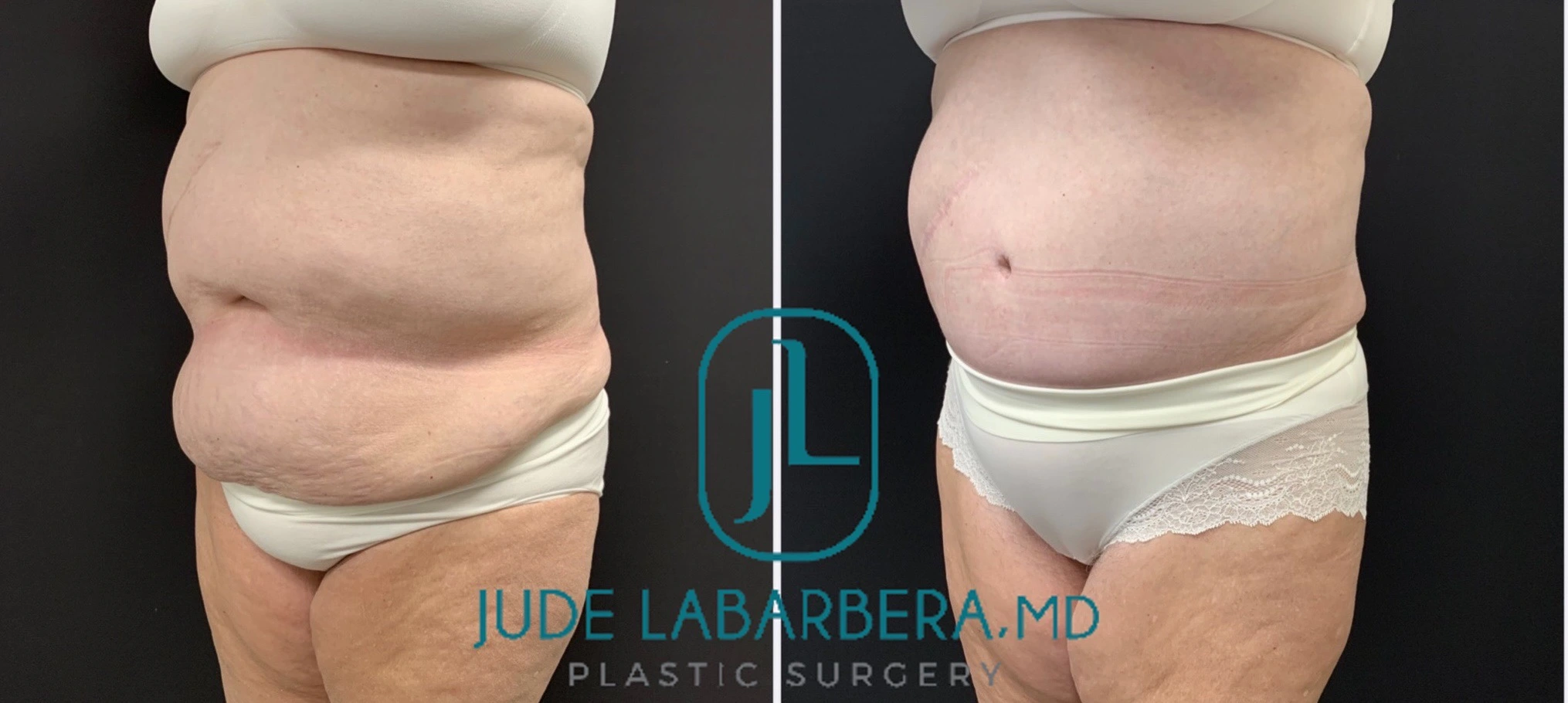 Tummy Tuck Before & After Case Number 00047