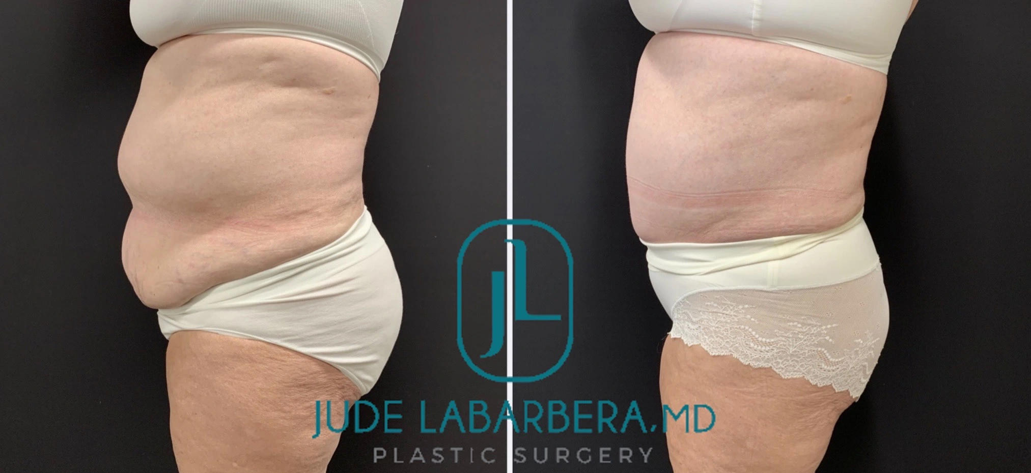 Tummy Tuck Before & After Case Number 00047