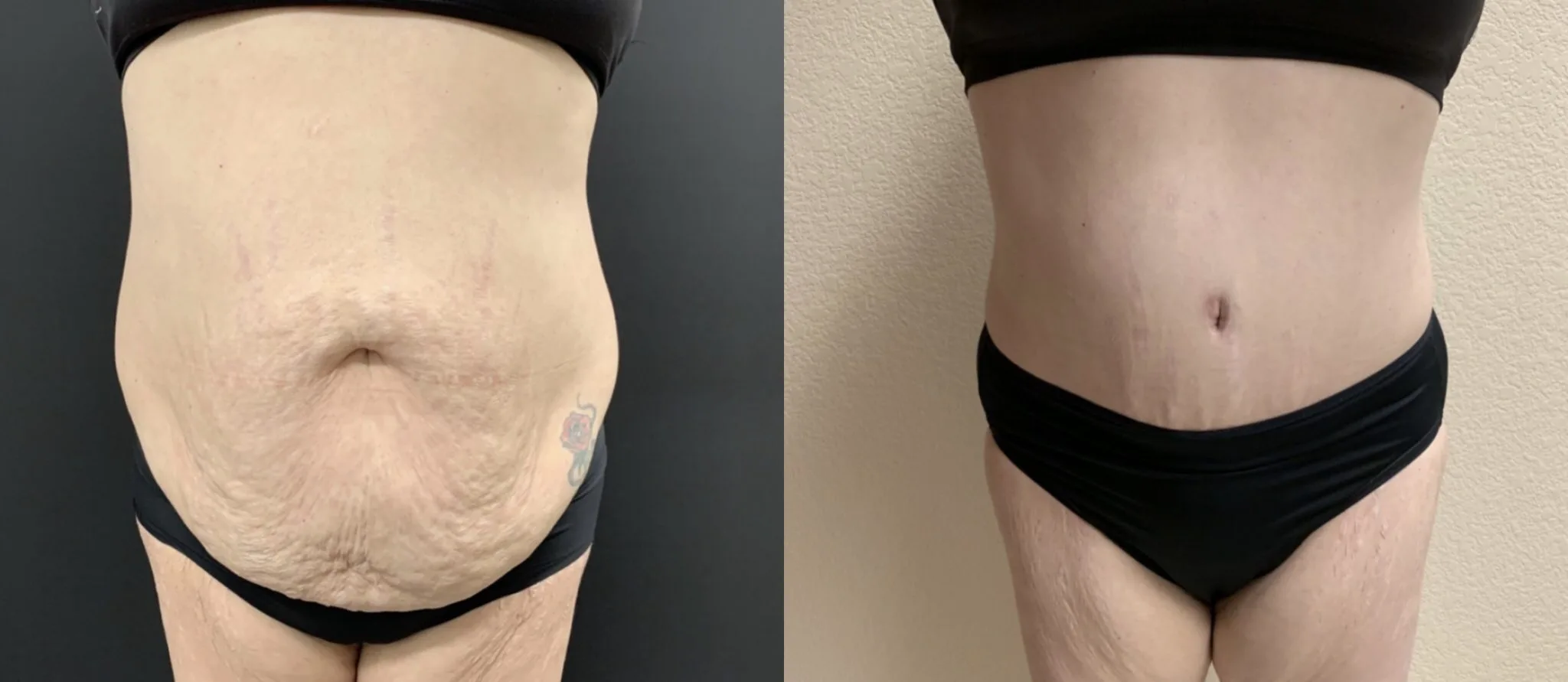 TUMMY TUCK Before & After Case Number 00053