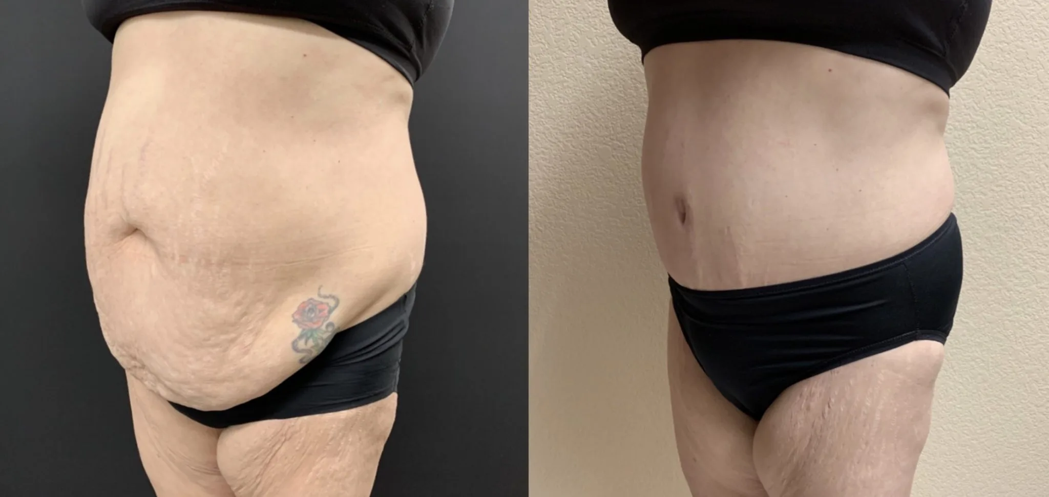 TUMMY TUCK Before & After Case Number 00053
