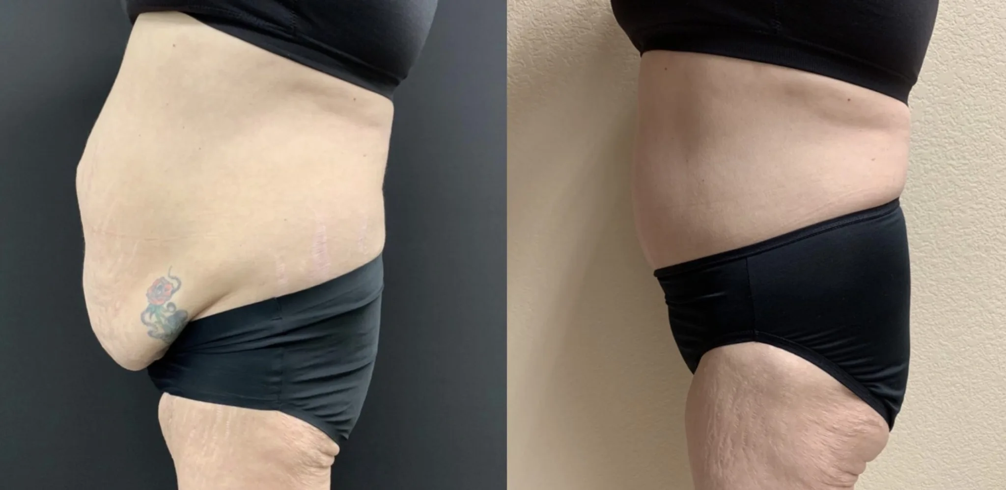 TUMMY TUCK Before & After Case Number 00053