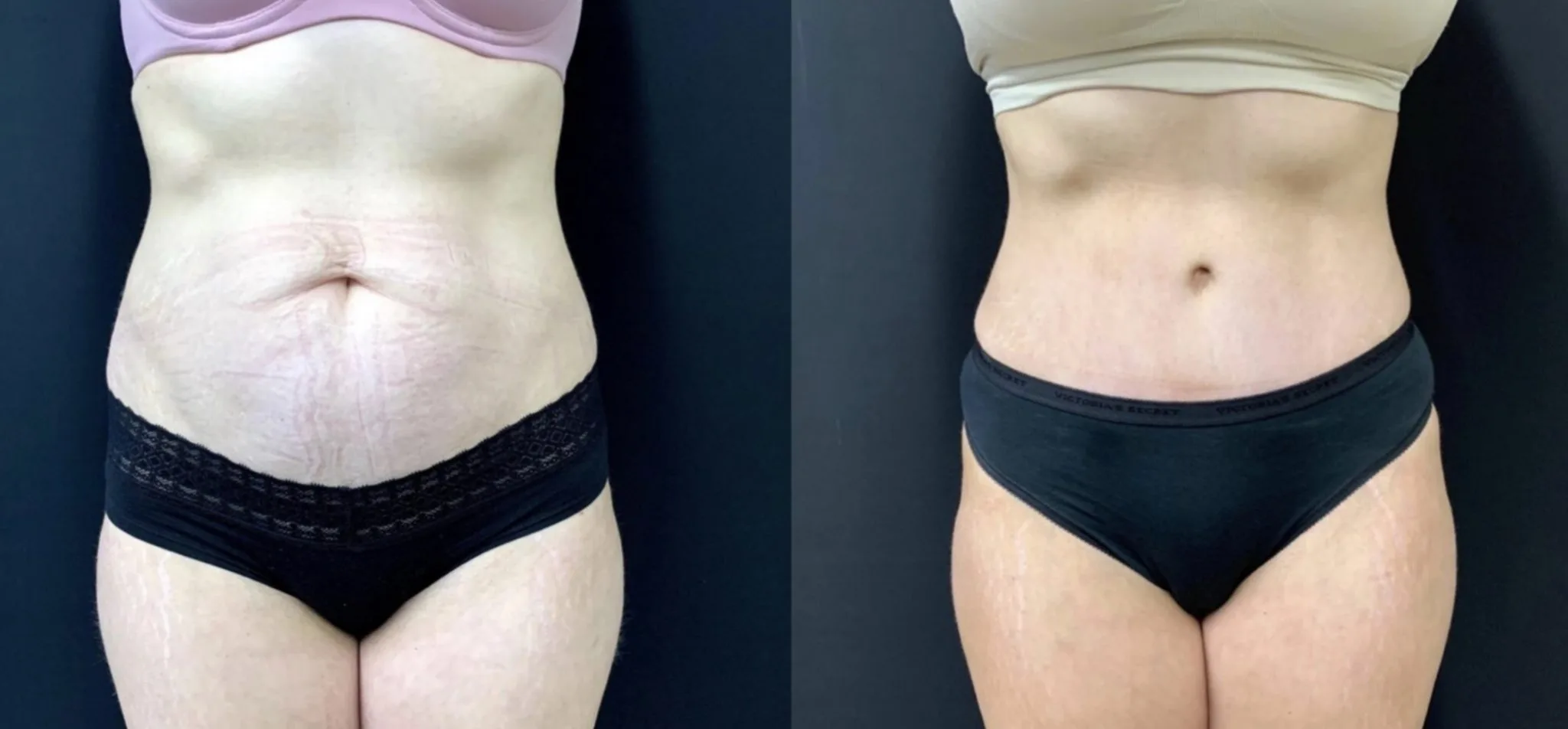 TUMMY TUCK Before & After Case Number 00054