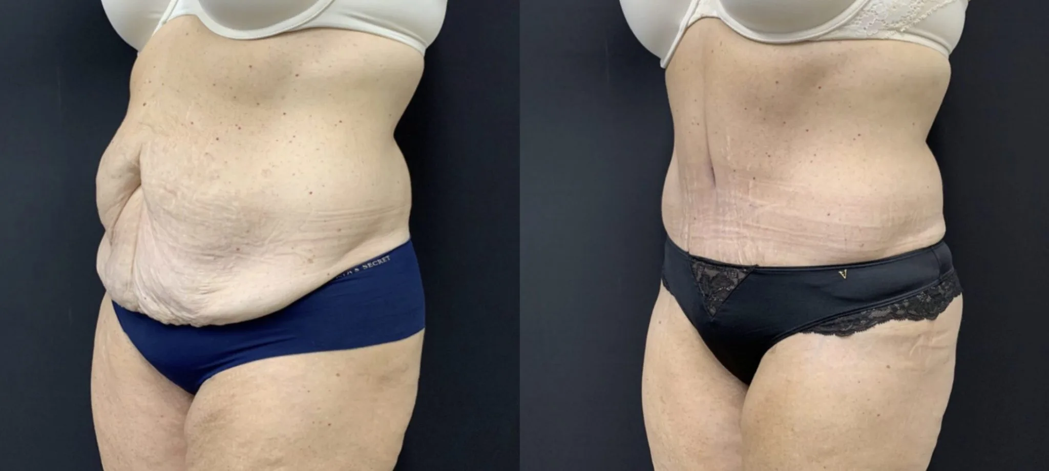 TUMMY TUCK Before & After Case Number 00055