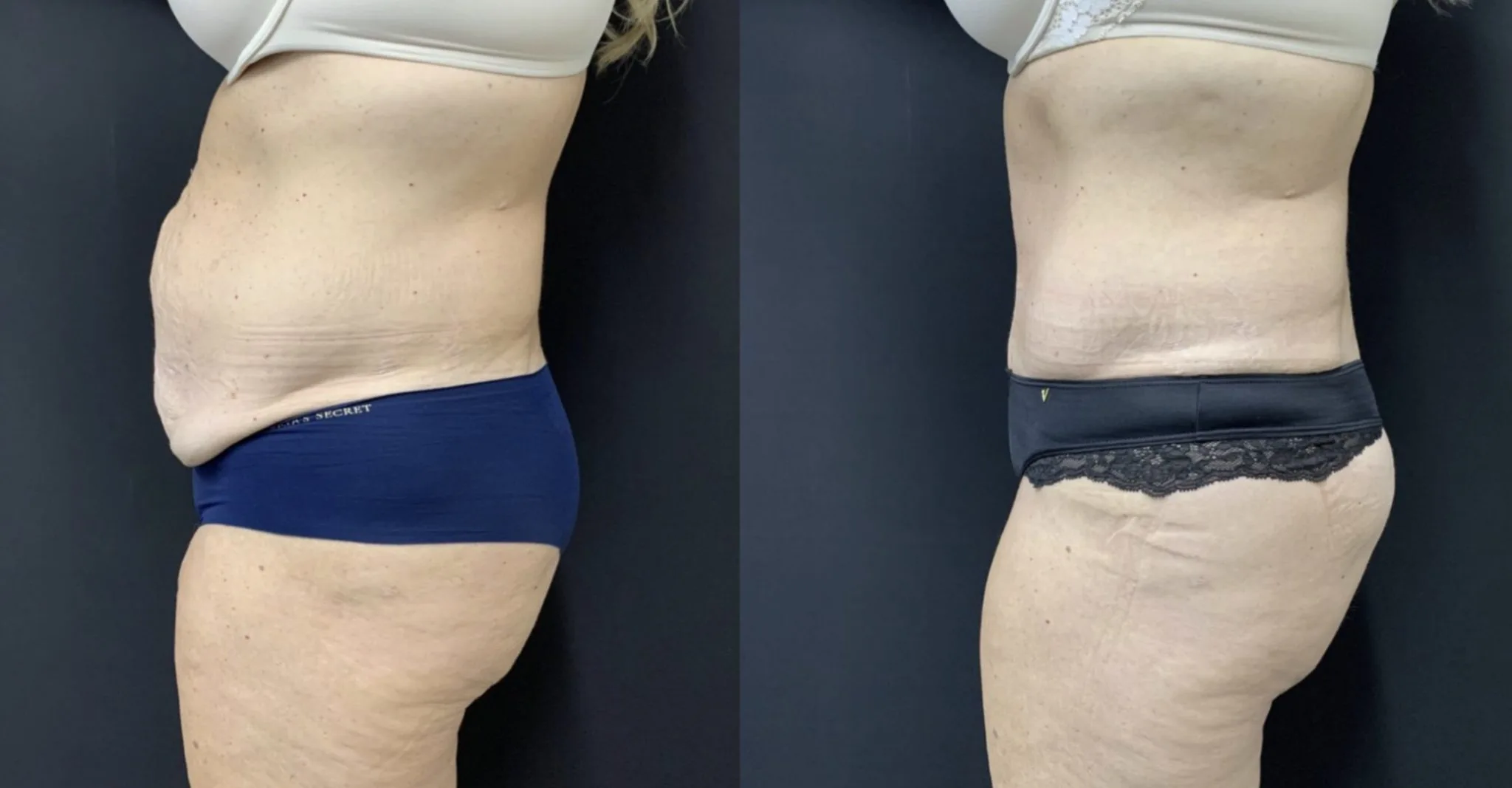TUMMY TUCK Before & After Case Number 00055
