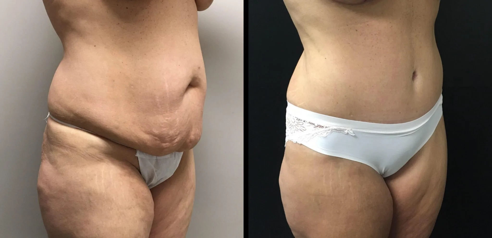TUMMY TUCK Before & After Case Number 00056