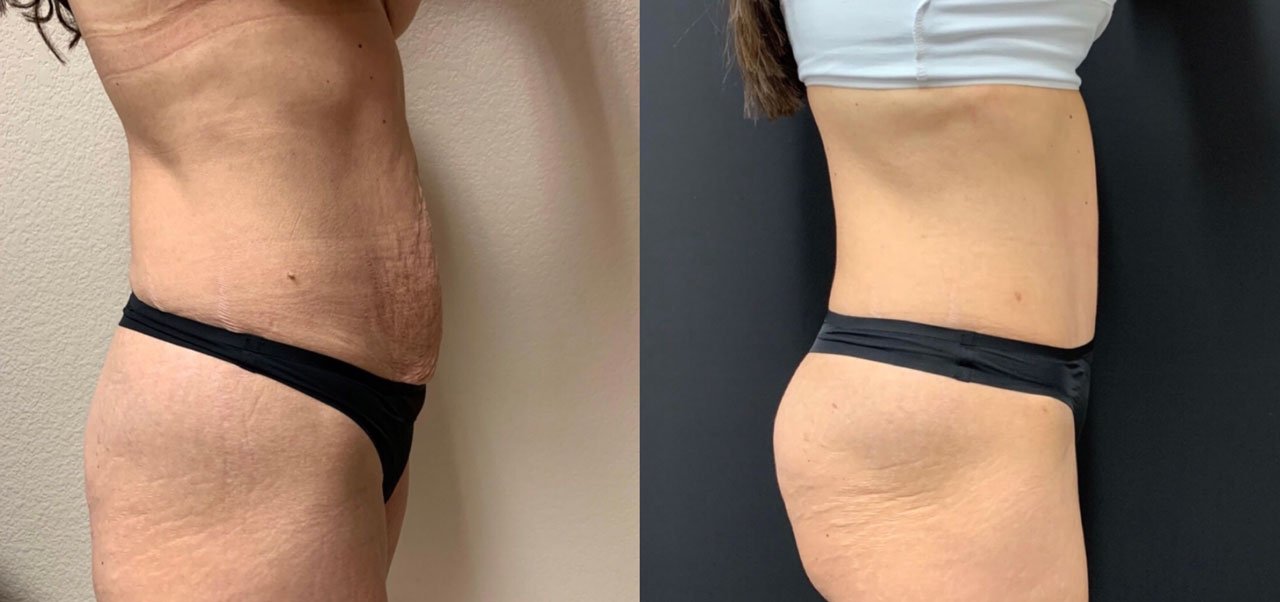 TUMMY TUCK Before & After Case Number 00057