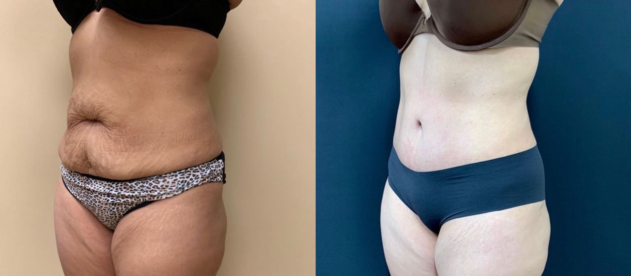 TUMMY TUCK Before & After Case Number 00059
