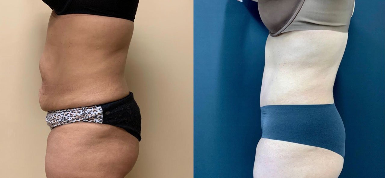 TUMMY TUCK Before & After Case Number 00059