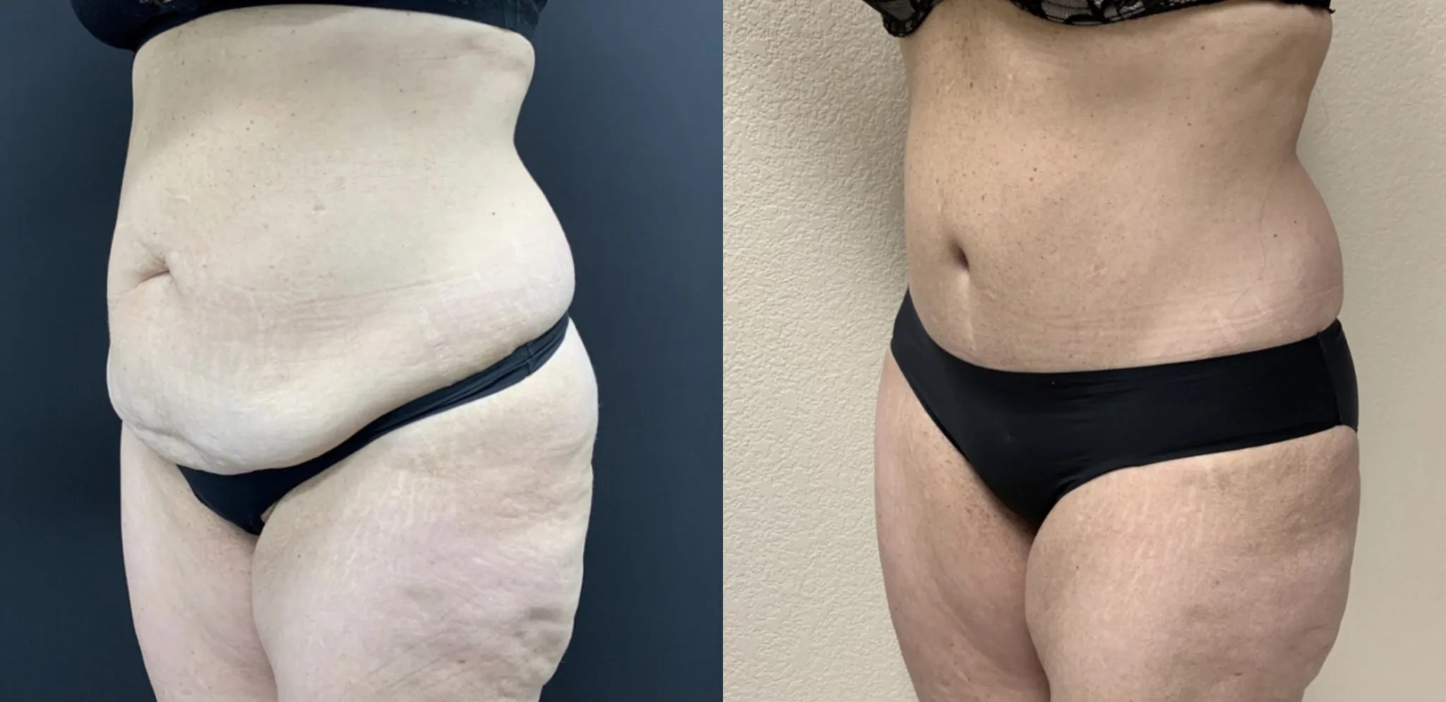 TUMMY TUCK Before & After Case Number 00059