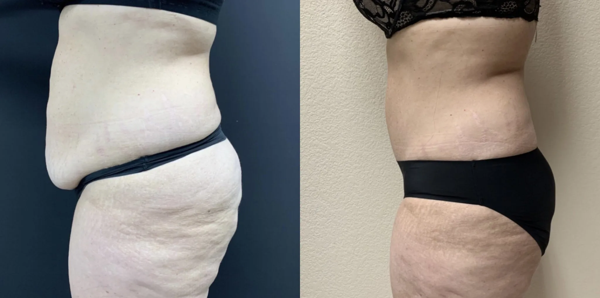TUMMY TUCK Before & After Case Number 00059
