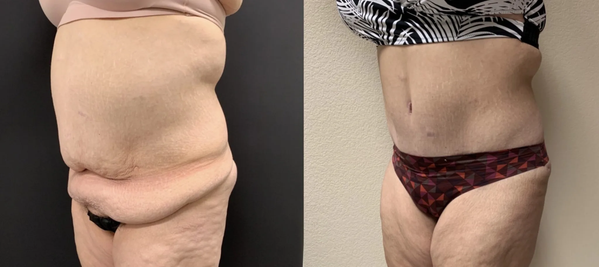 Tummy Tuck Before & After Case Number 0006