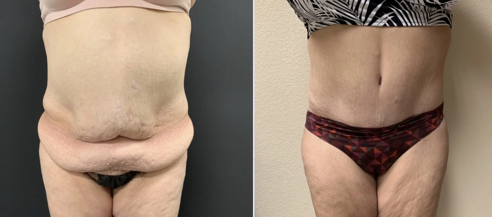Tummy Tuck Before & After Case Number 0006