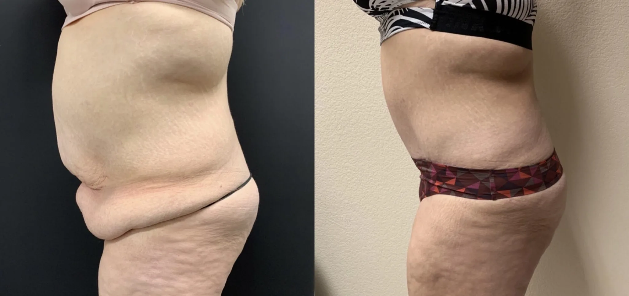 Tummy Tuck Before & After Case Number 0006